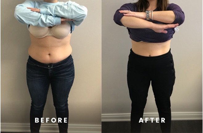 Before and After Houston TX Rapid hCG Weight Loss