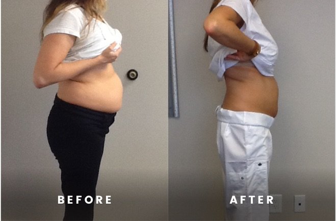 Before and After Aura MD Body Rapid hCG Weight Loss